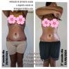 Drenagem linfática (pós operatório de abdominoplastia